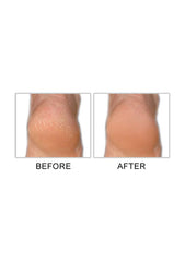 Before and after image showing callus removal results with Mr. Pumice Callus Terminator.